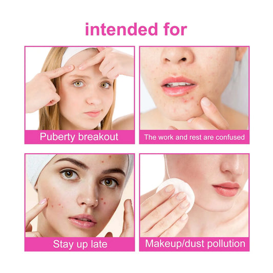 Pimple Patches for Face Cute Butterfly Shaped Acne Patches Hydrocolloid Cute Zit Stickers Parches Para Acne