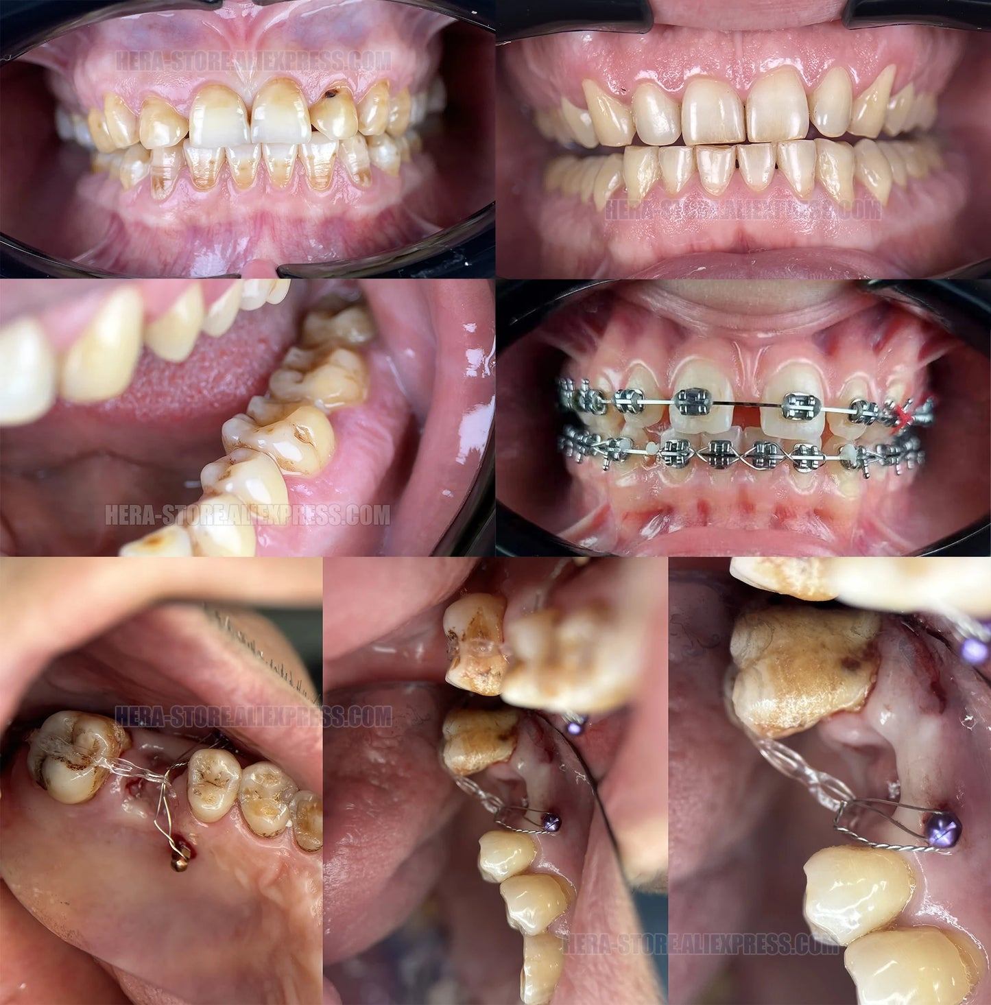 Dental Photo LED Light. Dental Photography Light. Macro, Polarizer, Intraoral, Denture Photo With Phone Lamp For Dentistry