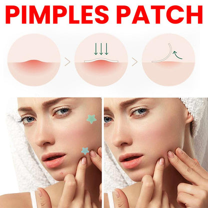 200 Patches Acnes Pimple Patches for Zits and Blemishes,Spots Treatments Stickers for Face and Skin