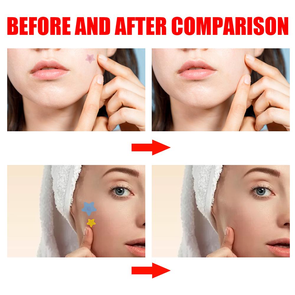 200 Patches Acnes Pimple Patches for Zits and Blemishes,Spots Treatments Stickers for Face and Skin