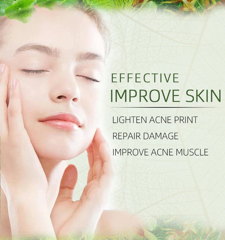 JoyPretty Herbal Acne Face Cream Body Pimple Treatment Oil Control Moisturizing Facial Creams Skin Care Products Beauty