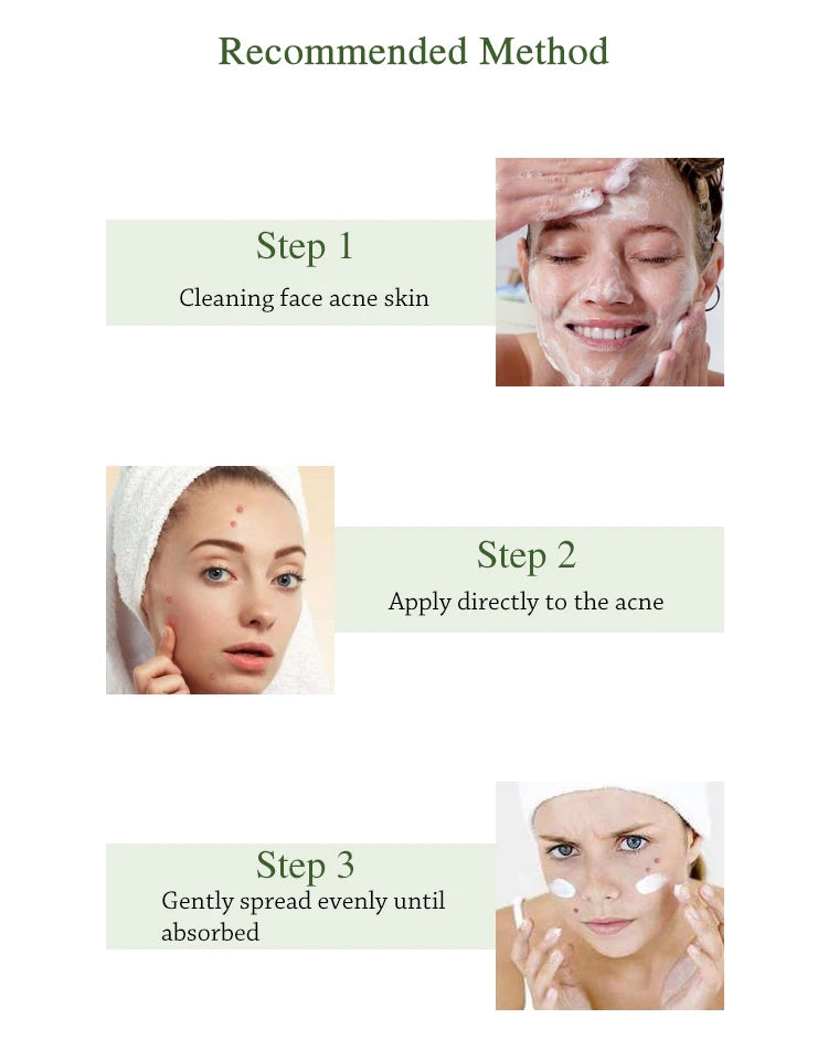 JoyPretty Herbal Acne Face Cream Body Pimple Treatment Oil Control Moisturizing Facial Creams Skin Care Products Beauty