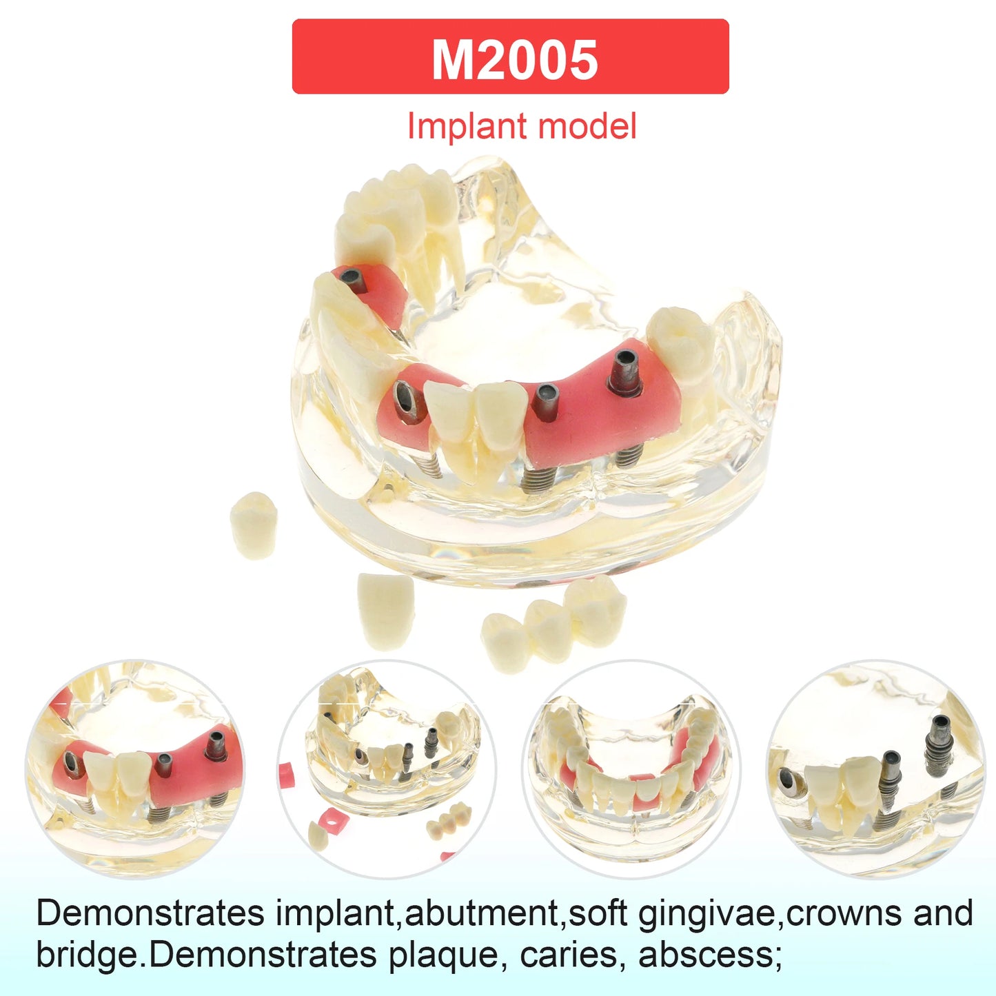 Dental Teeth Model Dental Teaching Models Implant Model Removable Dentistry Model Teeth For Training Studying Patient Education