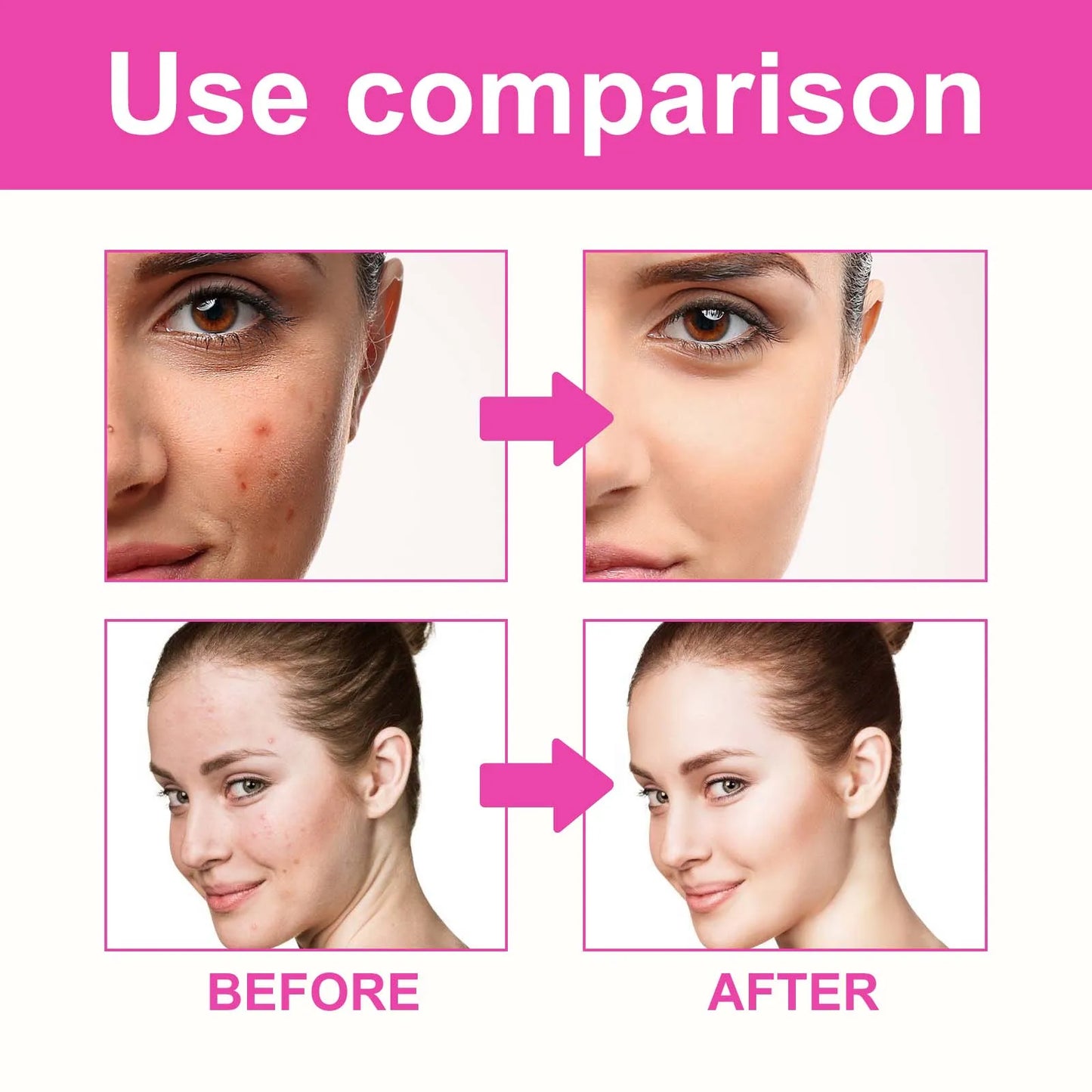 Pimple Patches for Face Cute Butterfly Shaped Acne Patches Hydrocolloid Cute Zit Stickers Parches Para Acne