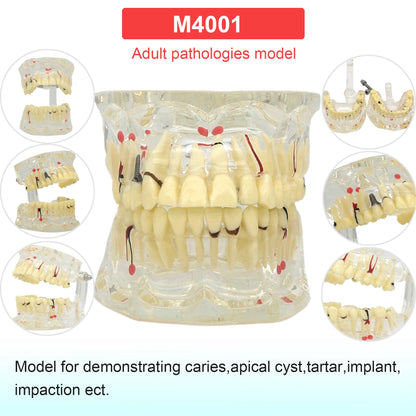Dental Teeth Model Dental Teaching Models Implant Model Removable Dentistry Model Teeth For Training Studying Patient Education