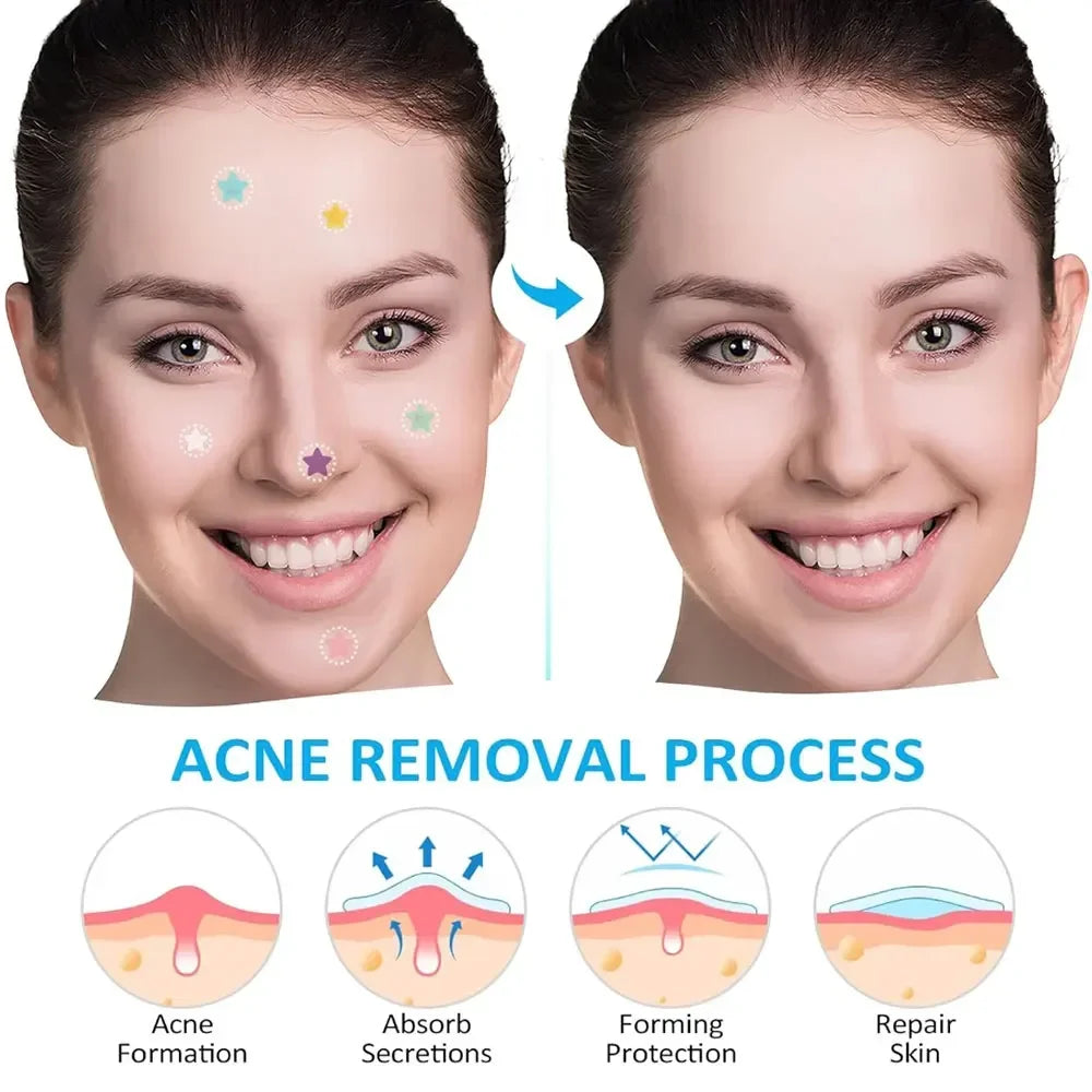 40pcs Colorful PE Pimple Patches Cute Star Shaped Cover Sticker Invisible Pimple Cover Removal Pimple Patch Skin Care