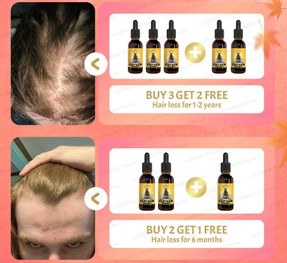 2025 Hair growth oil, repair baldness, hairline, rapid hair growth hair growth oil for men
