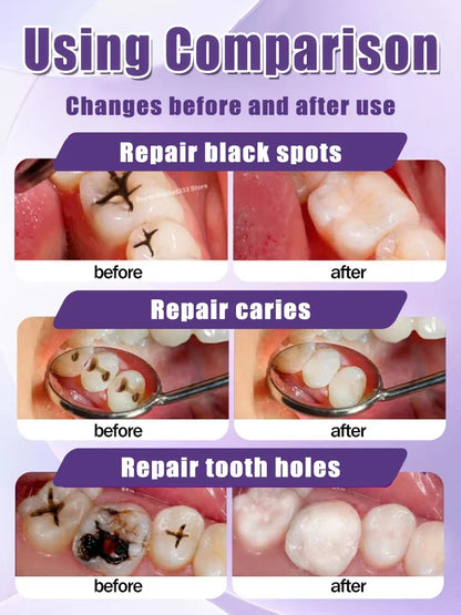 tooth decay repair tooth repair fast teeth whitening clean teeth teeth repair cavities tooth repair treatment