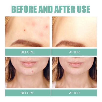 132Pcs Acne Pimple Patches Skin Blemish Treatment  Patches Professional Face Cleaning Care Invisible Large Hydrocolloid Sticker