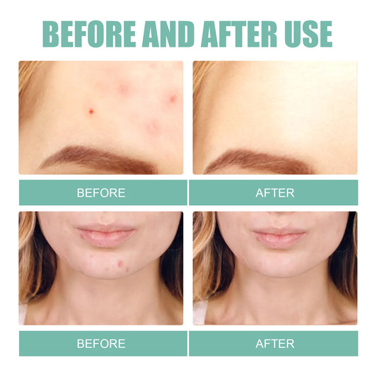 132Pcs Acne Pimple Patches Skin Blemish Treatment  Patches Professional Face Cleaning Care Invisible Large Hydrocolloid Sticker