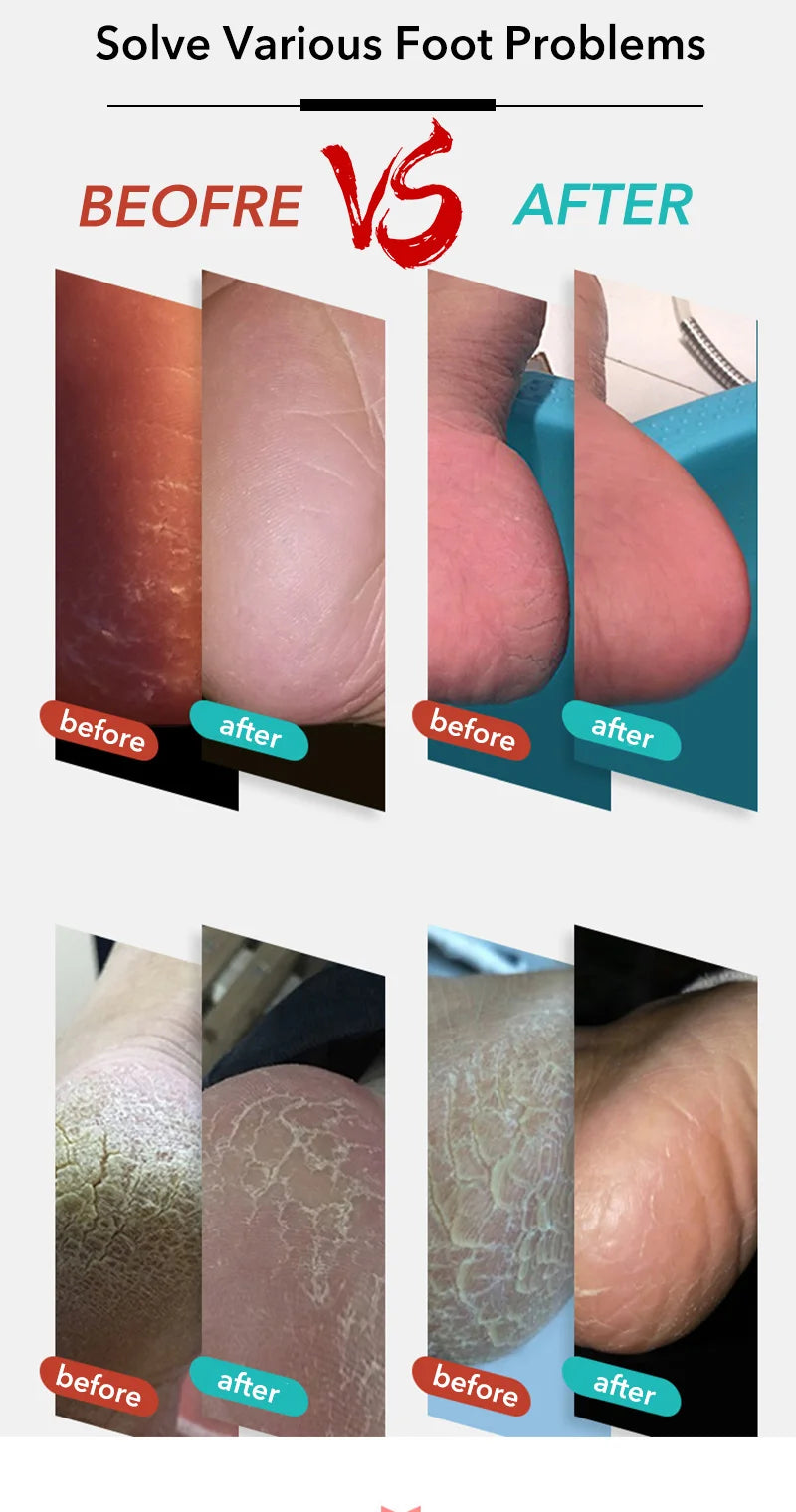 Professional Feet Care Tools Beauty Heel Cuticle Scraper Cutter Foot Care File Tool Pedicure Razor Blades for Pedicures Product