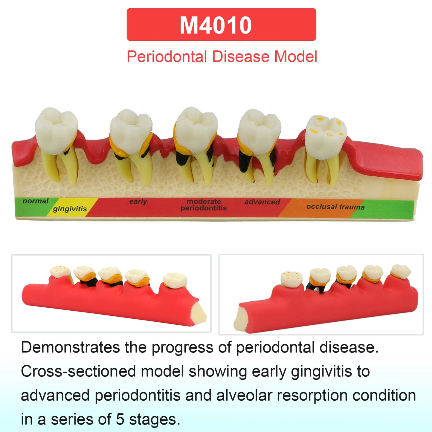 Dental Teeth Model Dental Teaching Models Implant Model Removable Dentistry Model Teeth For Training Studying Patient Education
