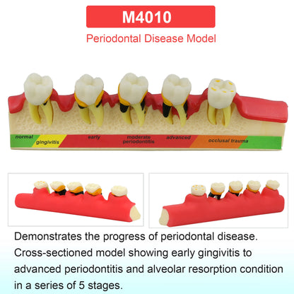 Dental Teeth Model Dental Teaching Models Implant Model Removable Dentistry Model Teeth For Training Studying Patient Education