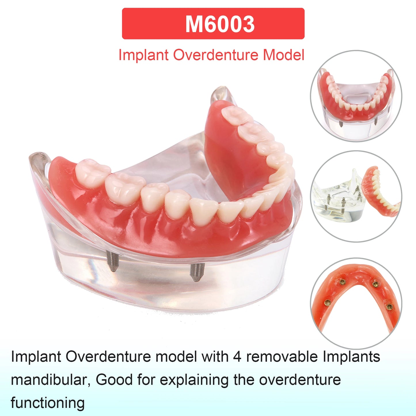 Dental Teeth Model Dental Teaching Models Implant Model Removable Dentistry Model Teeth For Training Studying Patient Education