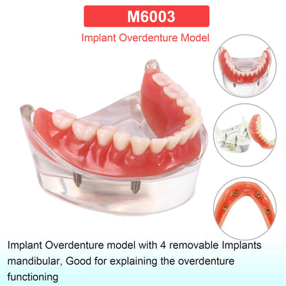 Dental Teeth Model Dental Teaching Models Implant Model Removable Dentistry Model Teeth For Training Studying Patient Education