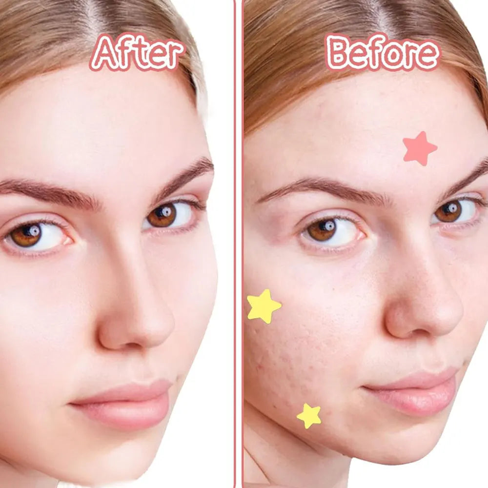40pcs Colorful PE Pimple Patches Cute Star Shaped Cover Sticker Invisible Pimple Cover Removal Pimple Patch Skin Care