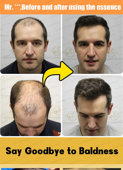 2025 Hair growth oil, repair baldness, hairline, rapid hair growth hair growth oil for men