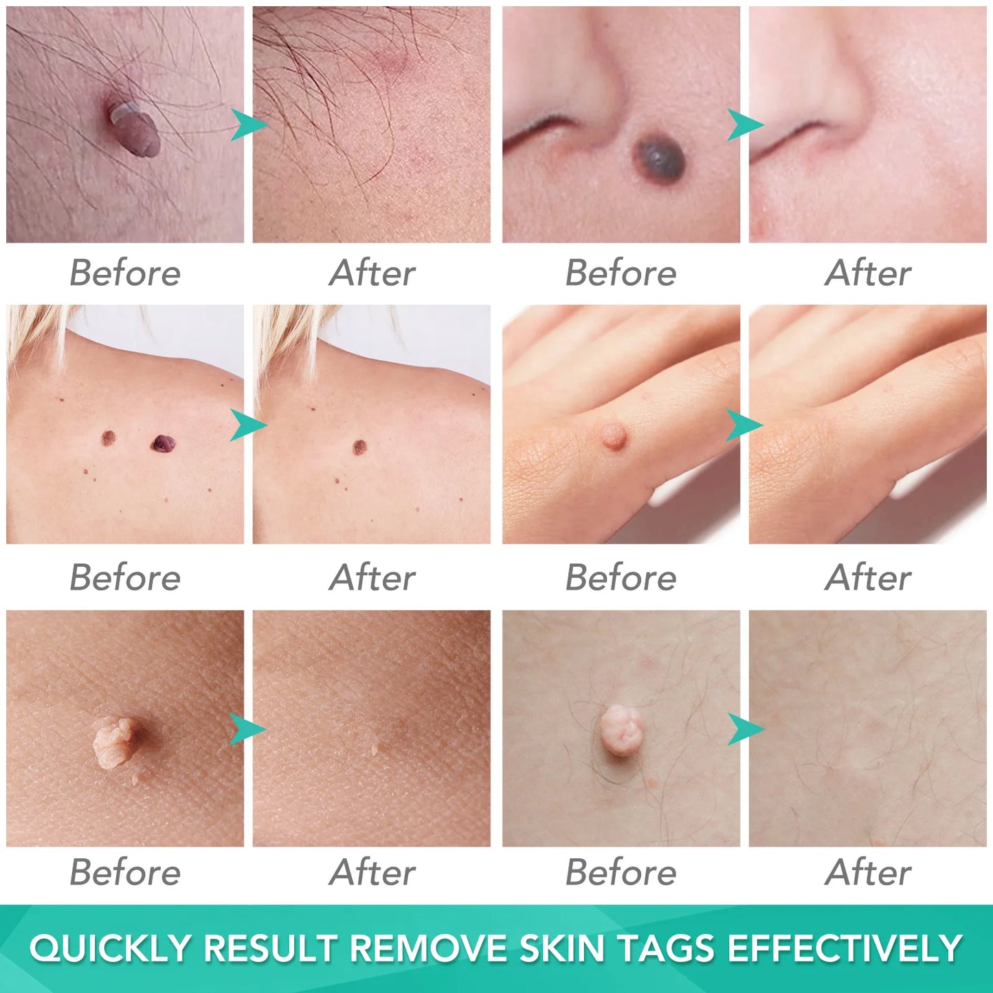 Simple Wart Removal Tool Set Skin Tag Removeal Tool Easy To Clean Skin Care Tool Skin Tag Removal Care Products