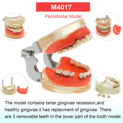 Dental Teeth Model Dental Teaching Models Implant Model Removable Dentistry Model Teeth For Training Studying Patient Education