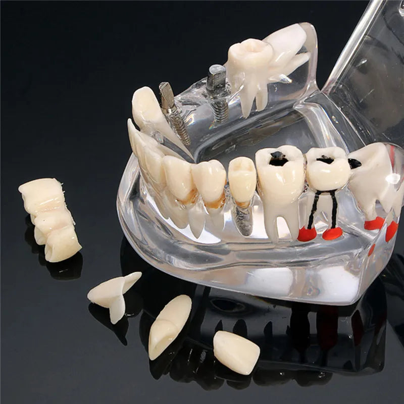 Dental Models Repairable Resin Models Of Diseased Teeth For Teaching And Research In Medicine And Dental Diseases