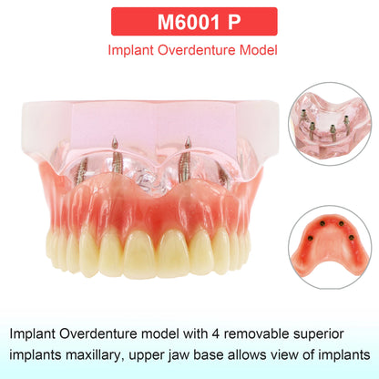 Dental Teeth Model Dental Teaching Models Implant Model Removable Dentistry Model Teeth For Training Studying Patient Education