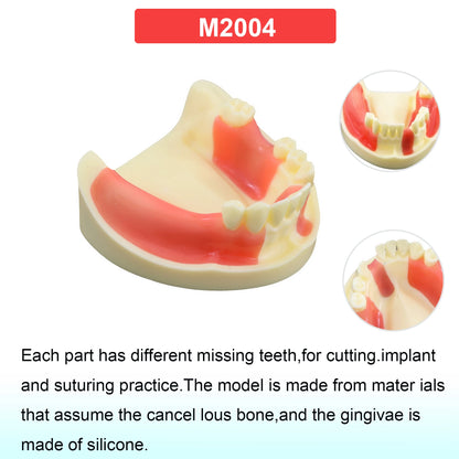 Dental Teeth Model Dental Teaching Models Implant Model Removable Dentistry Model Teeth For Training Studying Patient Education