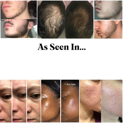 0.2-0.3mm Microneedle for Facial Body Hair Growth Derma Roller for Skin Beard 540 Needles Micro Face Roll Tool