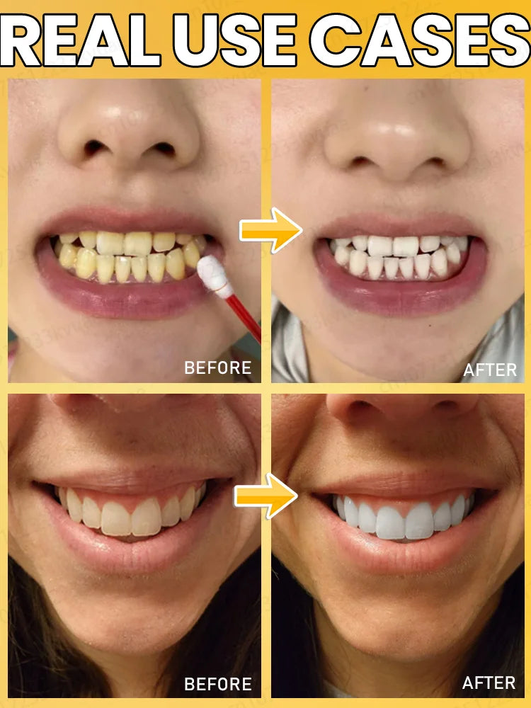 Home teeth whitening to protect your teeth