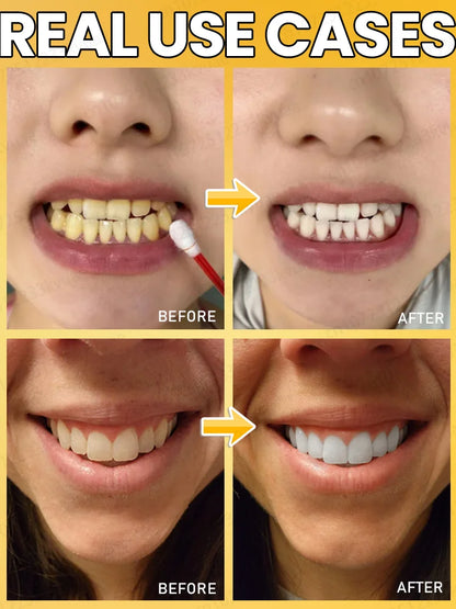 Home teeth whitening to protect your teeth