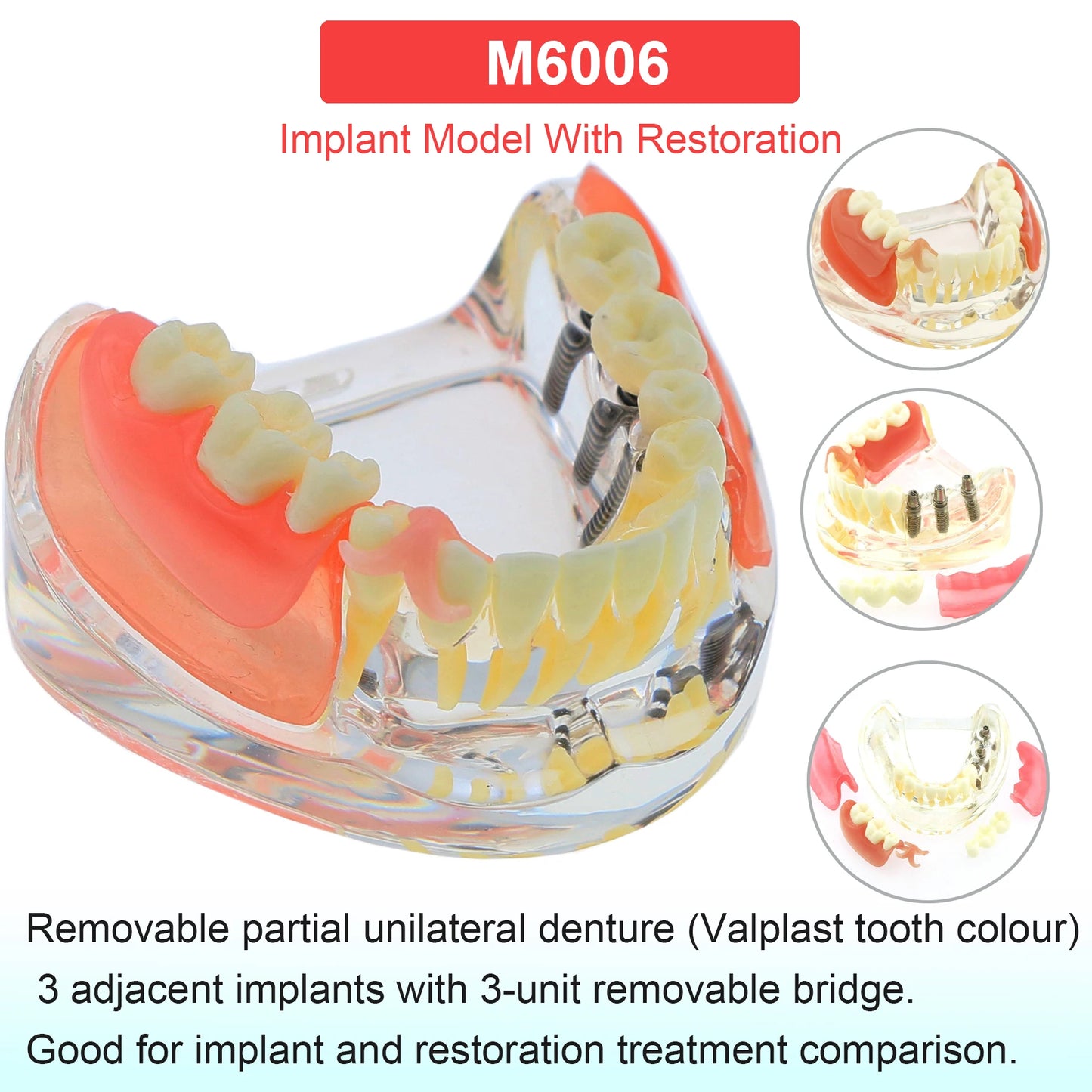 Dental Teeth Model Dental Teaching Models Implant Model Removable Dentistry Model Teeth For Training Studying Patient Education