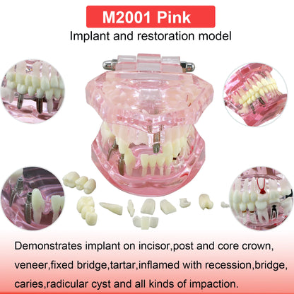 Dental Teeth Model Dental Teaching Models Implant Model Removable Dentistry Model Teeth For Training Studying Patient Education