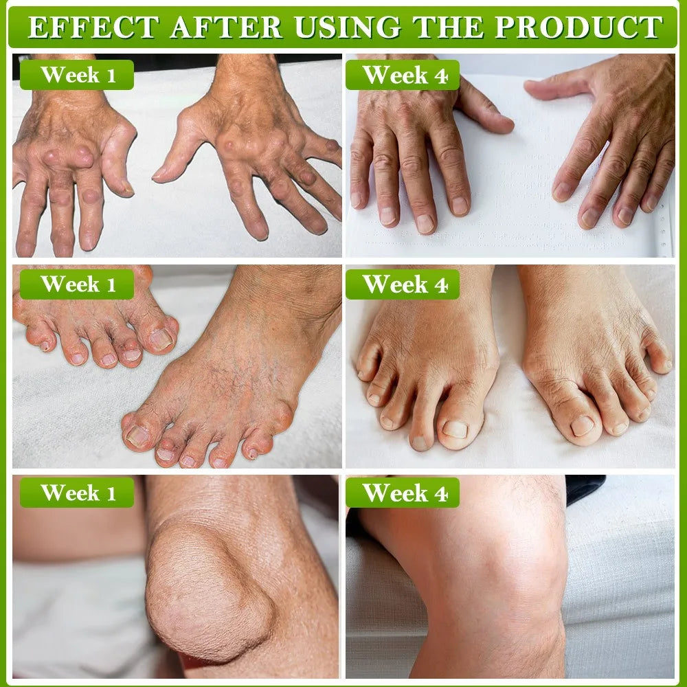 Bee Venom Joint Care Balm Care Lumbar Spine, Knee Muscle Pain, Muscle Soreness, Joint Care Balm Pure Natural Ingredients（30g）