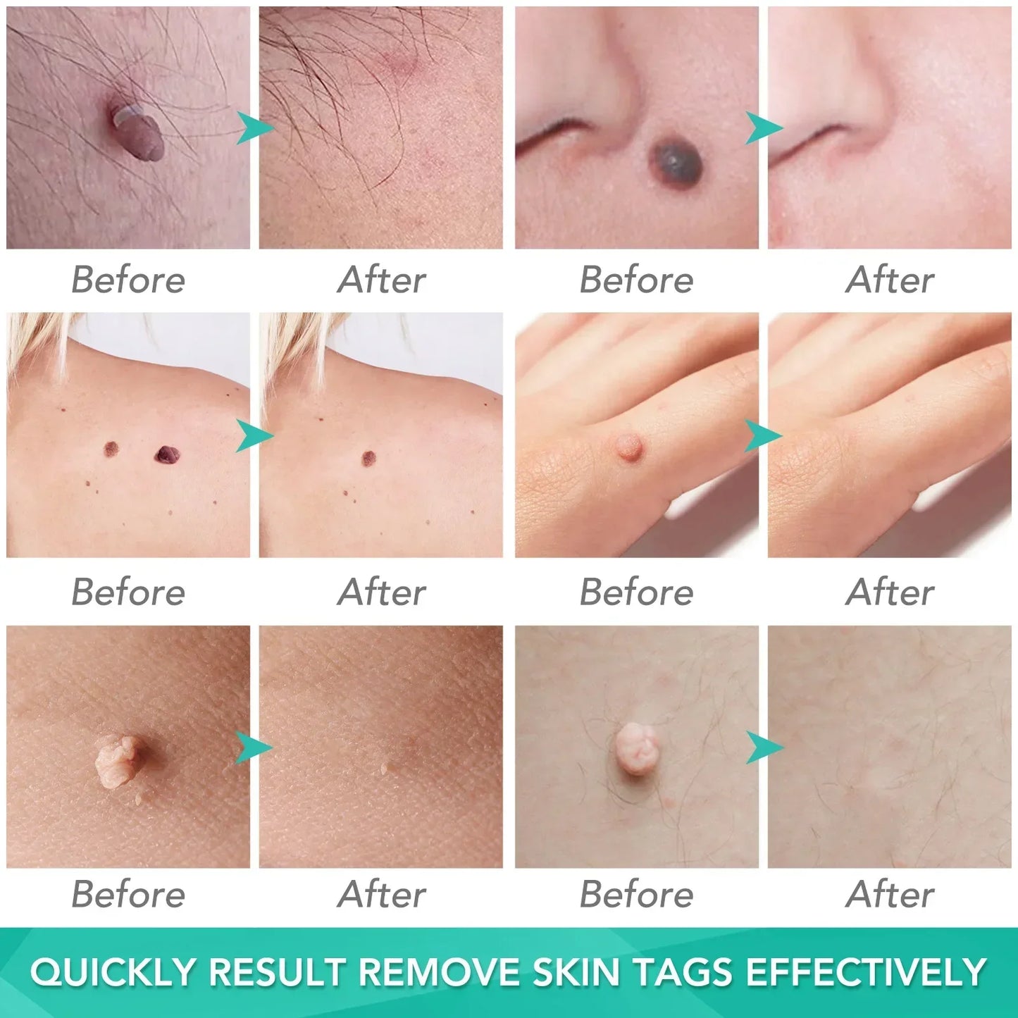 Simple Wart Removal Tool Set Skin Tag Removeal Tool Easy To Clean Skin Care Tool Skin Tag Removal Care Products