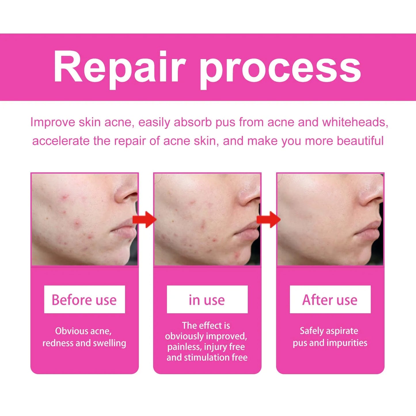 Pimple Patches for Face Cute Butterfly Shaped Acne Patches Hydrocolloid Cute Zit Stickers Parches Para Acne