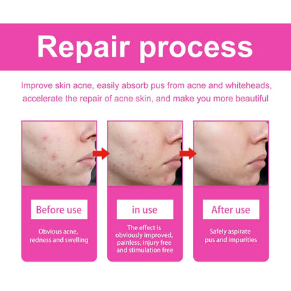 Pimple Patches for Face Cute Butterfly Shaped Acne Patches Hydrocolloid Cute Zit Stickers Parches Para Acne