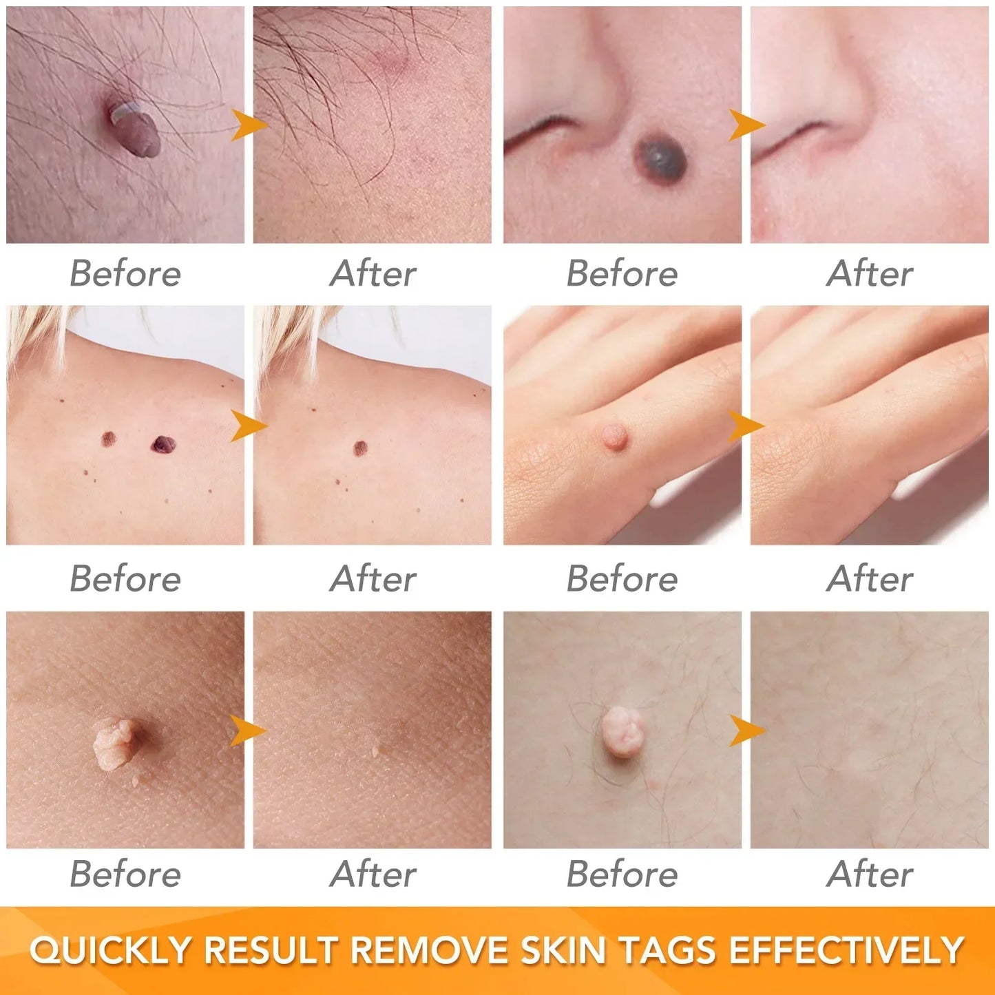 Simple Wart Removal Tool Set Skin Tag Removeal Tool Easy To Clean Skin Care Tool Skin Tag Removal Care Products