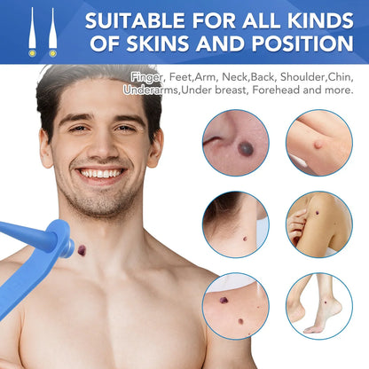 Simple Wart Removal Tool Set Skin Tag Removeal Tool Easy To Clean Skin Care Tool Skin Tag Removal Care Products