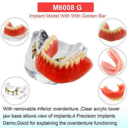 Dental Teeth Model Dental Teaching Models Implant Model Removable Dentistry Model Teeth For Training Studying Patient Education
