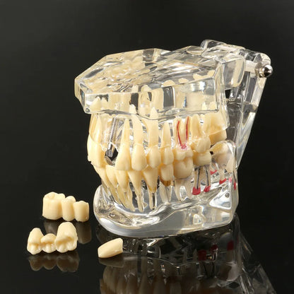 Dental Models Repairable Resin Models Of Diseased Teeth For Teaching And Research In Medicine And Dental Diseases