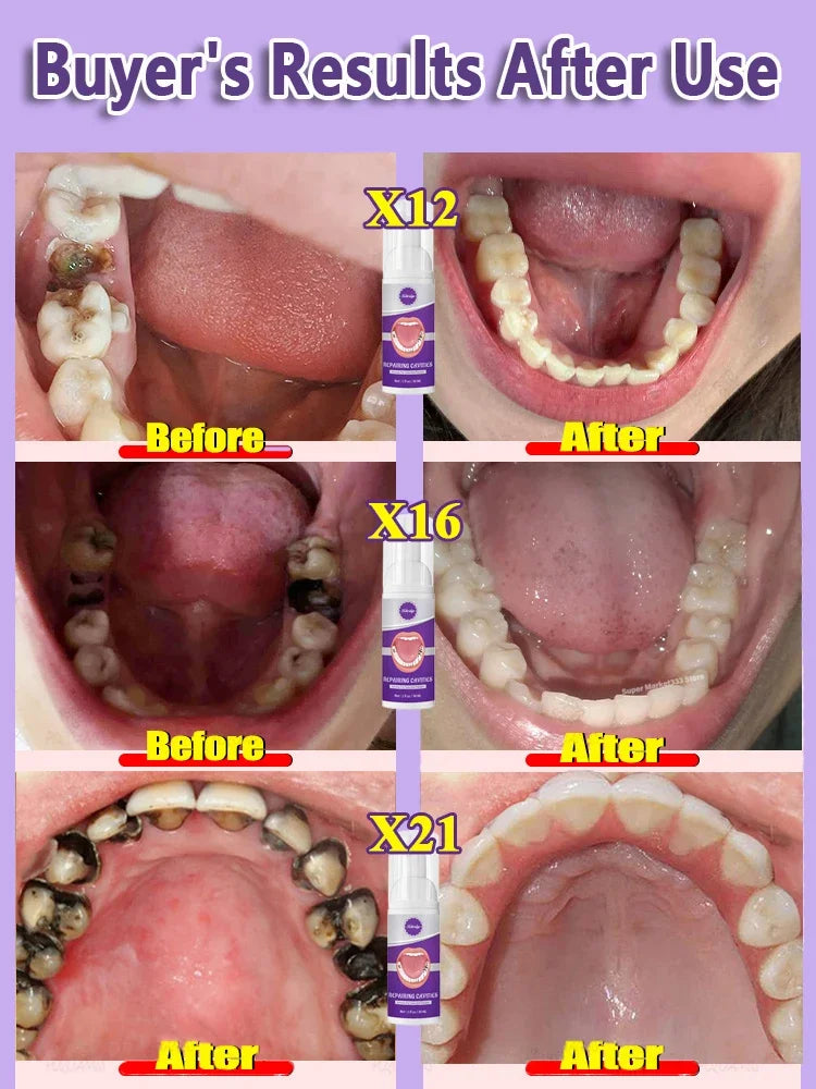 tooth decay repair tooth repair fast teeth whitening clean teeth teeth repair cavities tooth repair treatment