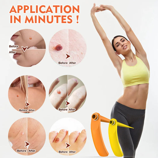 2-IN-1 Auto Skin Tag Removal Tool Kit Painless Skin Label Mole Acne Wart Removal Pen with Cleansing Swabs Facial Skin Care Tool