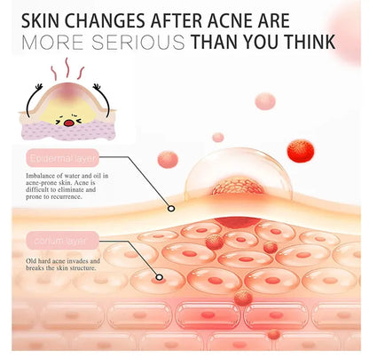 Pimple Patch Invisible Beauty Concealer Breathable Face Care Gentle Non-Irritating Purifying Pores Portable Transparent