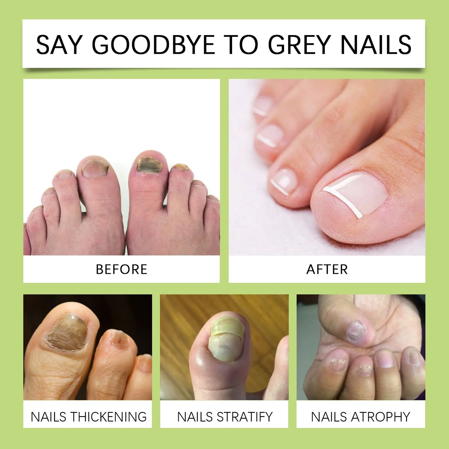 Nail Serum, Healthy Nails Nail Care Serum, Nail  Serum Honey Grapefruit Extract Nail Care Serum,fungus Nail Care,15ML/0.51FL.OZ