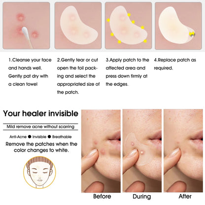 20 Patches Acne Patch Pimple Patches Blemish Protective Cover Absorbing Spot  Hydrocolloid Dressing Zit Sticker 28ED