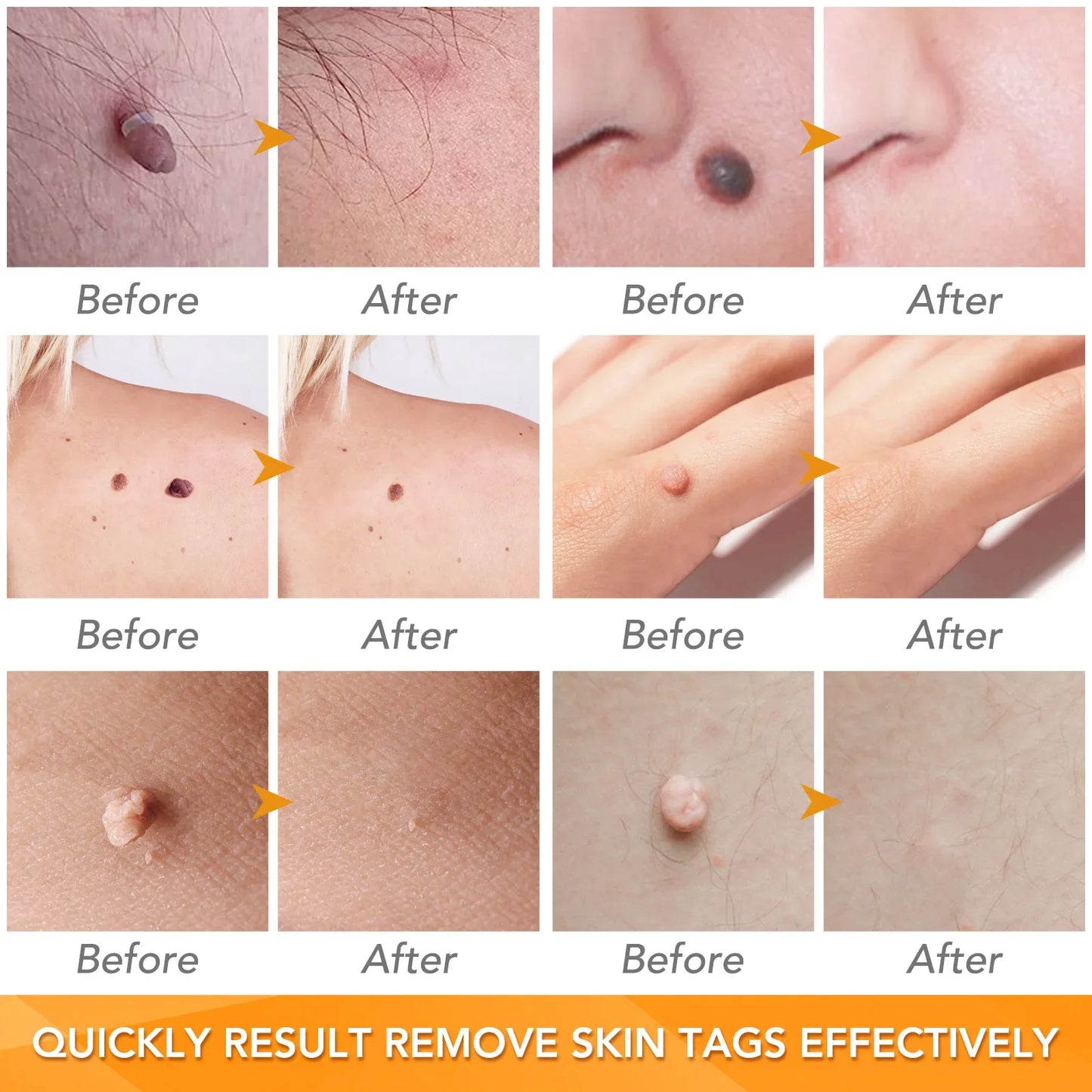 Simple Wart Removal Tool Set Skin Tag Removeal Tool Easy To Clean Skin Care Tool Skin Tag Removal Care Products