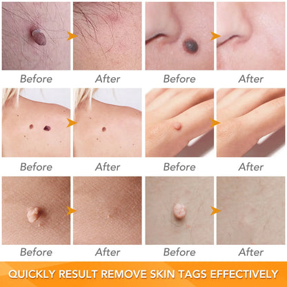 Simple Wart Removal Tool Set Skin Tag Removeal Tool Easy To Clean Skin Care Tool Skin Tag Removal Care Products