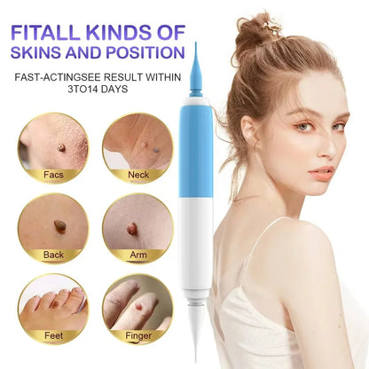 Skin Tag Removal Tool Rubber Rings Face Beauty Accessories Skin Tag Removal Device Multipurpose Supplies for Face Neck Chin Back