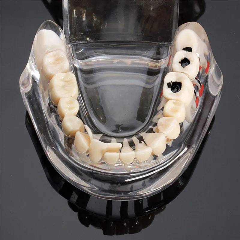 Dental Models Repairable Resin Models Of Diseased Teeth For Teaching And Research In Medicine And Dental Diseases