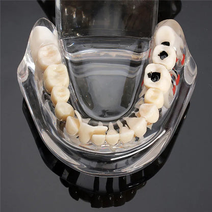Dental Models Repairable Resin Models Of Diseased Teeth For Teaching And Research In Medicine And Dental Diseases