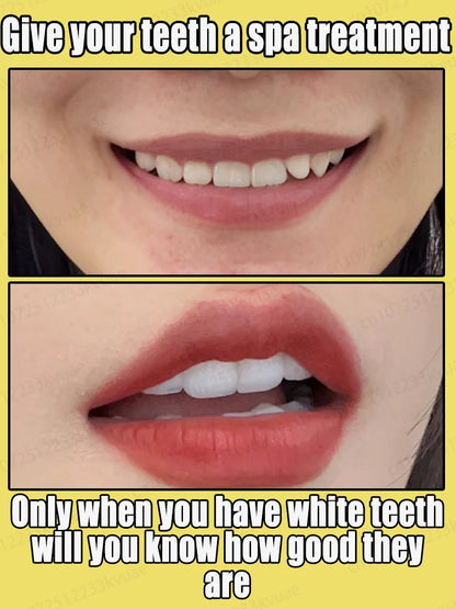 Home teeth whitening to protect your teeth